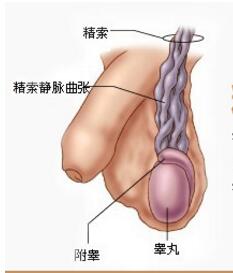 患有精索静脉曲张有什么要注意