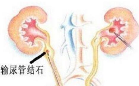 患有输尿管结石该如何护理