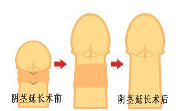 哪些男性应该做阴茎延长手术