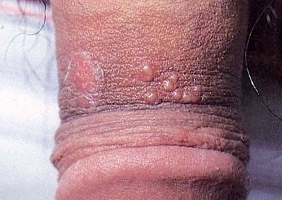 生殖器疱疹的症状都有哪些