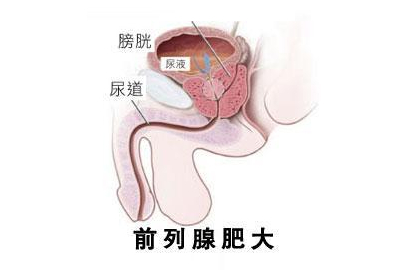 哪些习惯会导致前列腺肿大