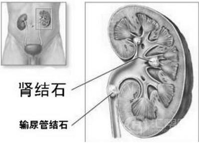 腰疼是不是肾结石的症状
