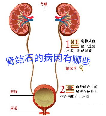 引起肾结石的原因有哪些