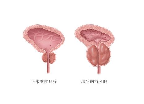 前列腺增生需要做哪些检查